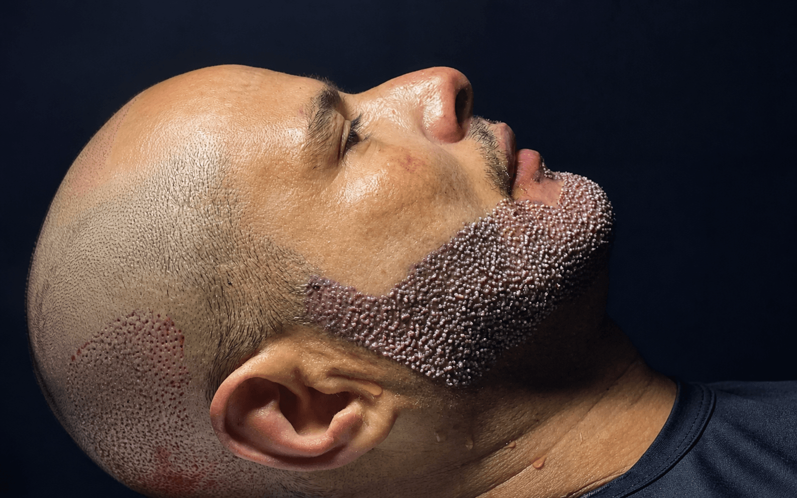 Beard Transplant — FKT Aesthetics