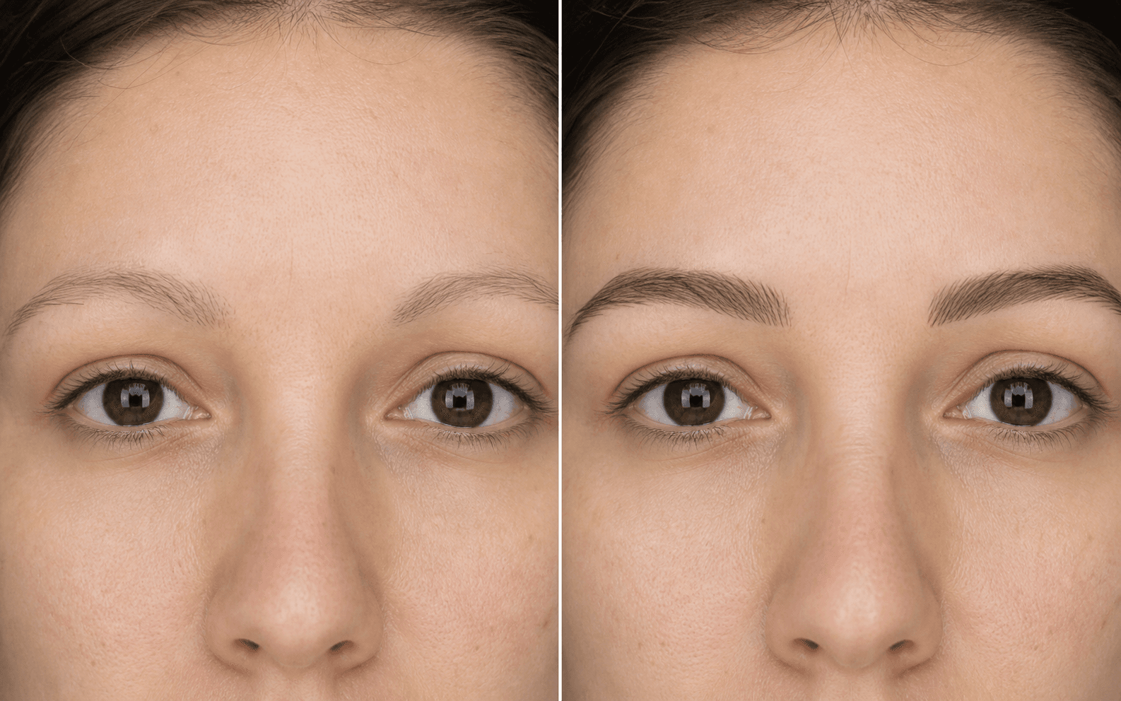 Eyebrow Transplant — FKT Aesthetics