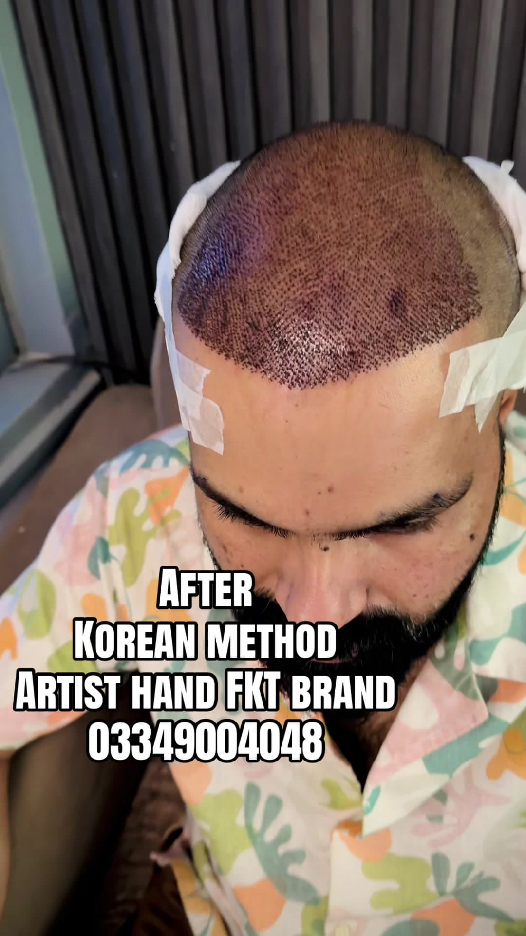 FKT hair-restoration video TikTok cover