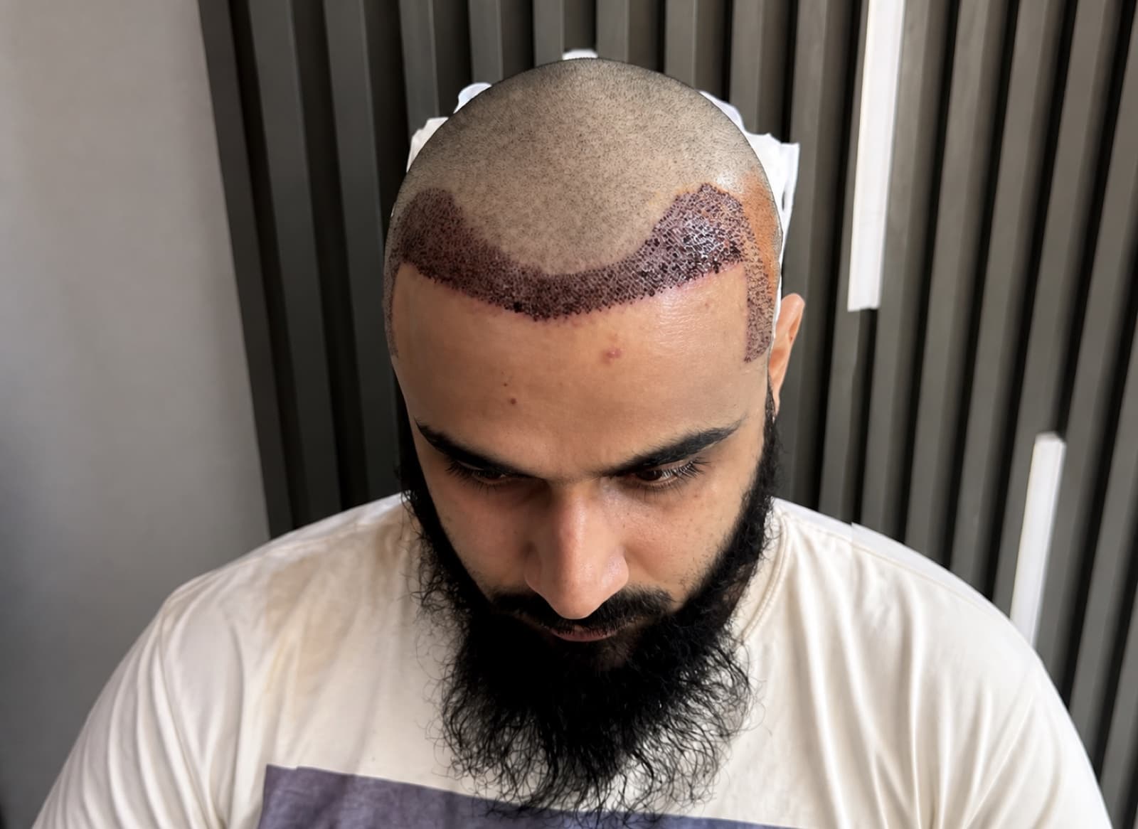 Frontal Session — FKT Aesthetics